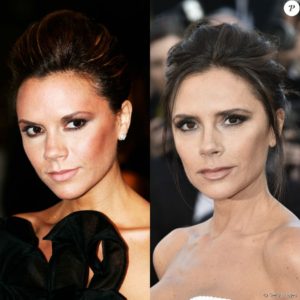 Victoria Beckham afinou o rosto após se submeter a uma bichectomia